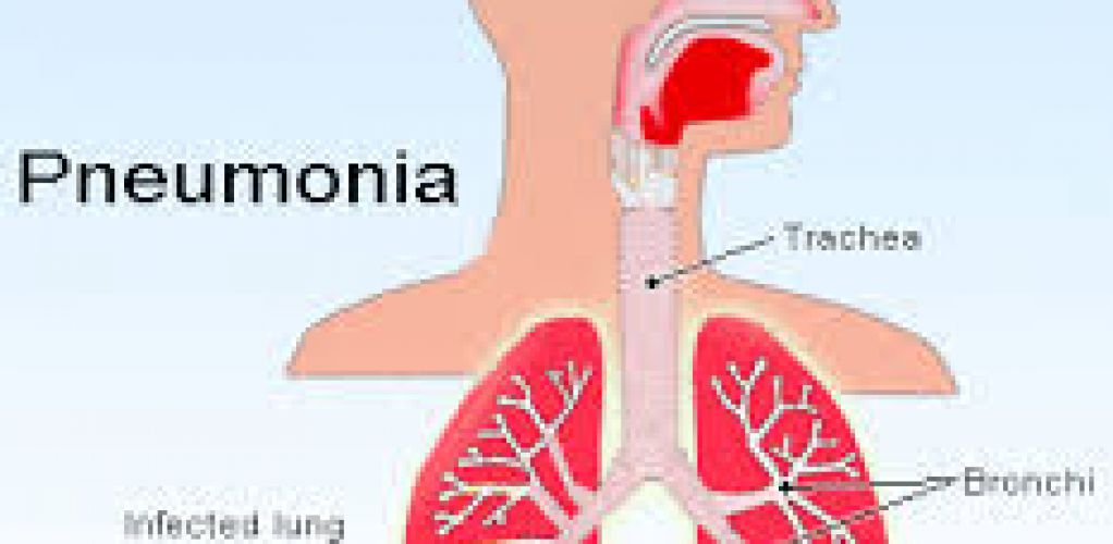 Lebih dari 800 Ribu Anak Indonesia Terserang Pneumonia Selama Tahun 2016