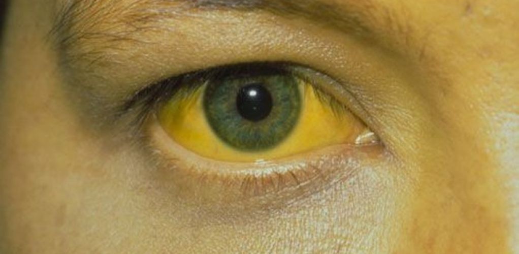 Waspada Hepatitis A, Yuk Kenali Dari Sekarang